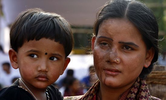 Acid attack survivor with her child in Bangladesh, 2010